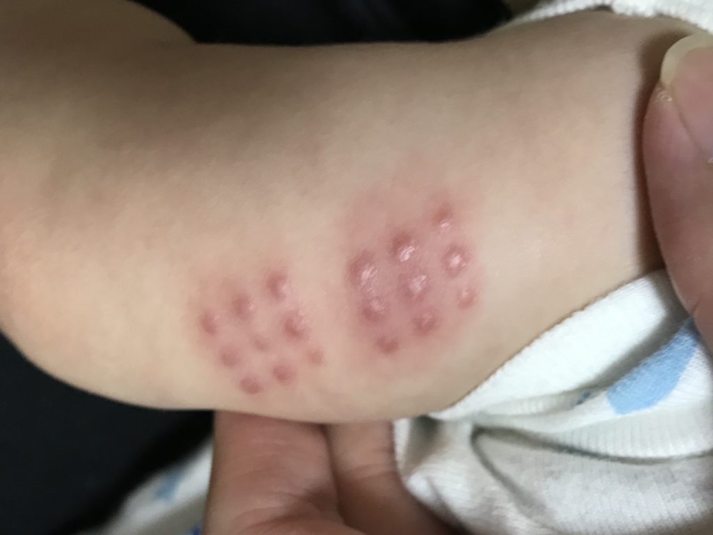 g予防接種跡 経過3ヶ月分の写真を公開 ハンコ注射跡画像有 ぷーたむパパママblog